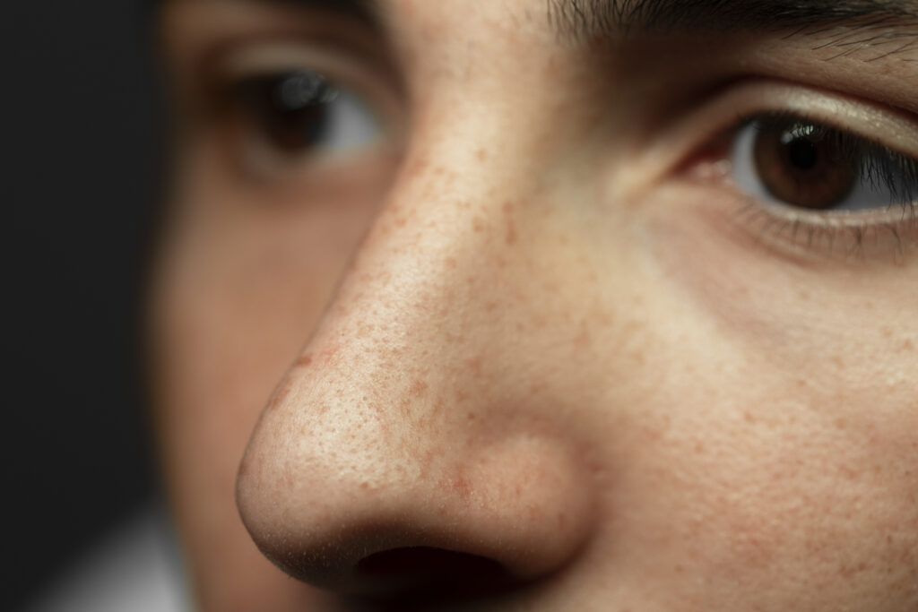 BLACKHEADS