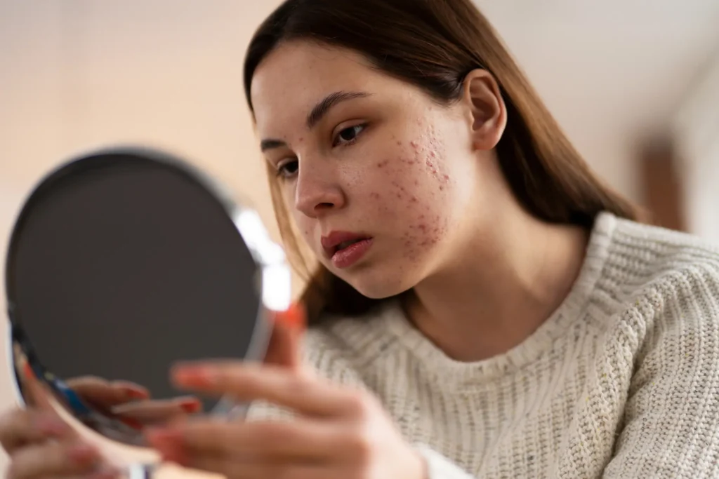 Acne Care