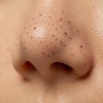 Blackheads