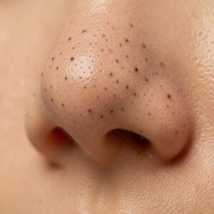 Blackheads